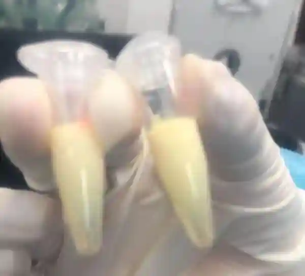 后悔！30岁杭州厨师小伙抽出乳白色的“牛奶血”，他的这个习惯很多人都有