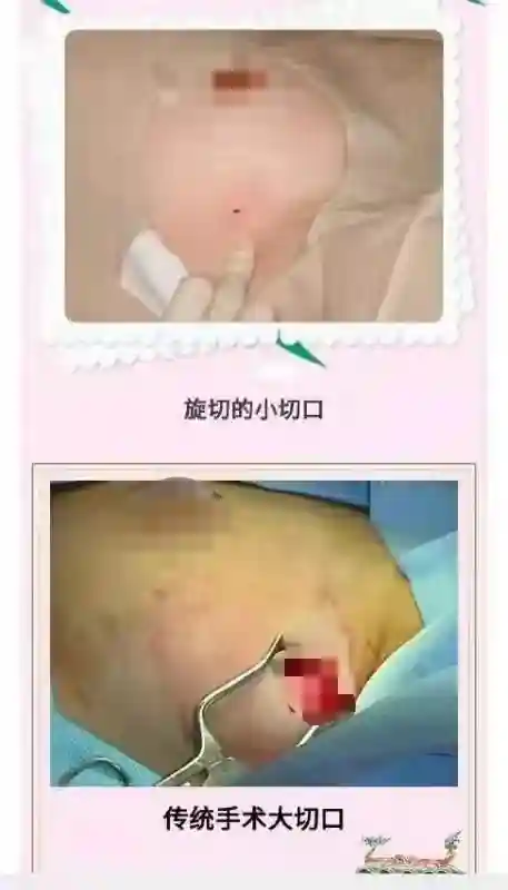 重庆市东南医院普外乳腺专科开展超声引导下真空辅助乳腺微创旋切术